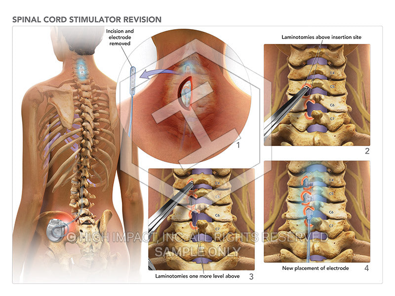 Spinal Cord Stimulator Trial