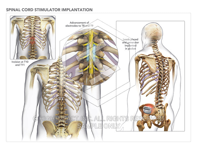 Image 09384: Spinal Cord Stimulator Illustration