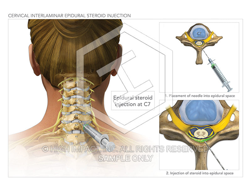 Image 10462: Cervical Epidural and Trigger Point Injections Illustrati