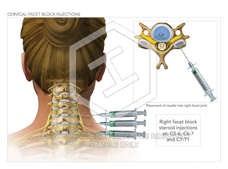 spinal facet injections