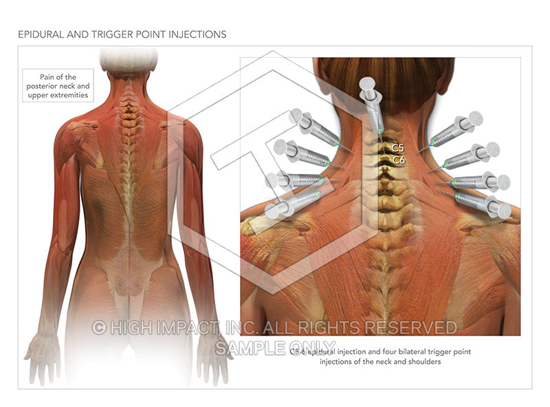 Trigger Point Injections – Center for Pain Relief