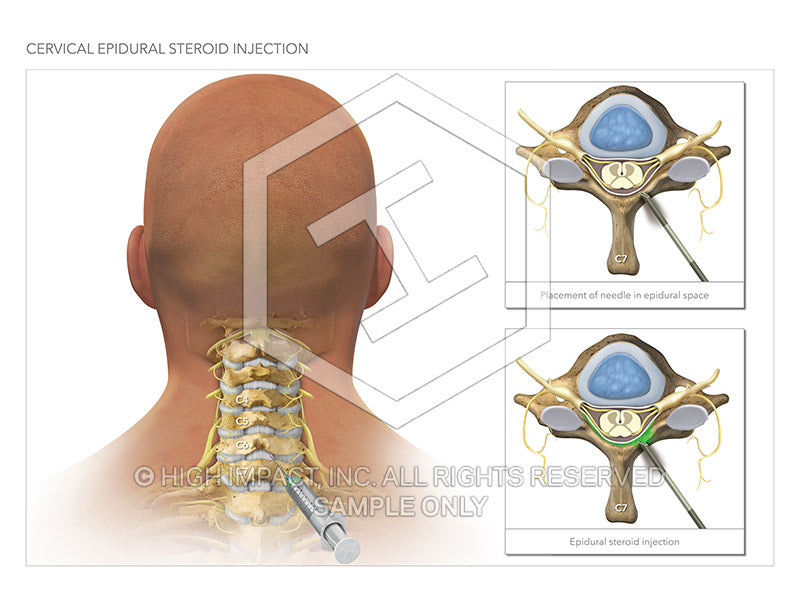 Cervical Placement for Neck Issues Example 