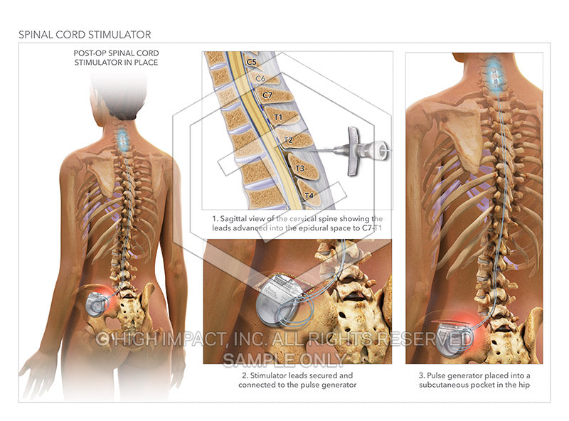 Spinal Cord Stimulation - Spine One