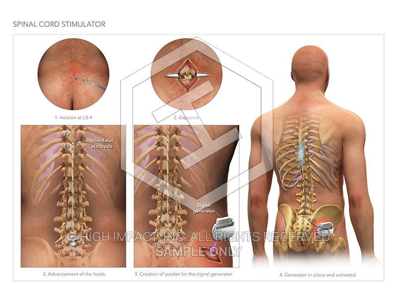 Quality at a Steal Image 14373: Spinal Cord Stimulator Illustration, back  stimulator 