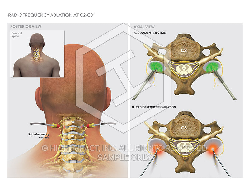 Stock Spine: Cervical Spine — Illustrated Verdict