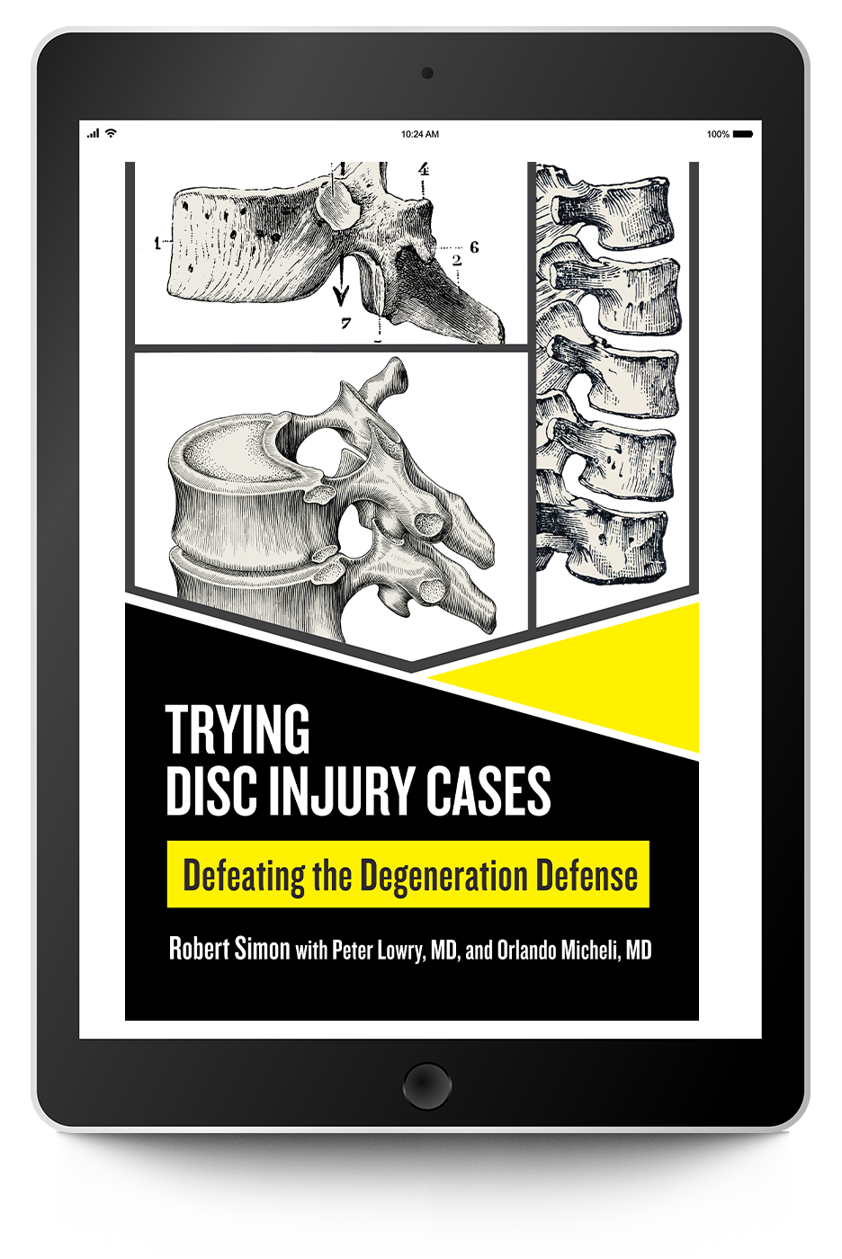 Trying Disc Injury Cases: Defeating the Degeneration Defense - Trial Guides