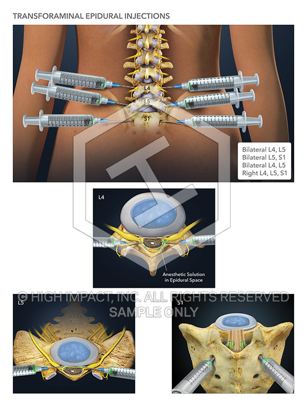 Image 08298_im03: Transforaminal Epidural Injections Illustration - Trial Guides