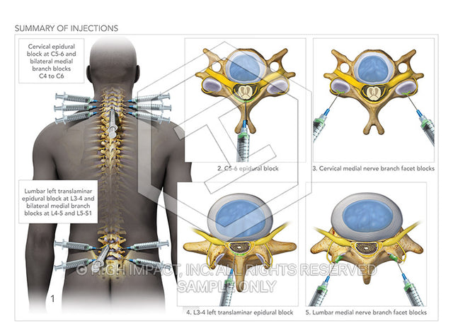 Image 08906: Spinal Pain Management Injection Illustration