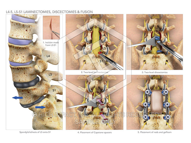 Image 08922: L4-5, L5-S1 Laminectomies, Discectomies & Fusion Illustration - Trial Guides