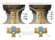 Image 09175: Cervical Spine Medial Branch Blocks and Radiofrequency Neuroablation Illustration